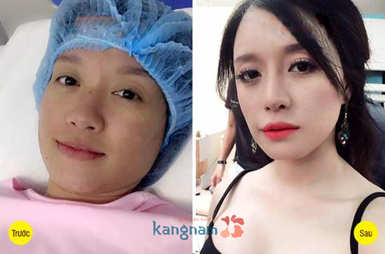Hình ảnh trước và sau cắt mí mắt, bấm mí mắt Hàn Quốc7799