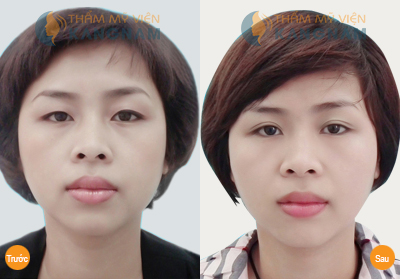 Làm gì để chống lại tình trạng sụp mí? Làm gì để chống lại tình trạng sụp mí?3