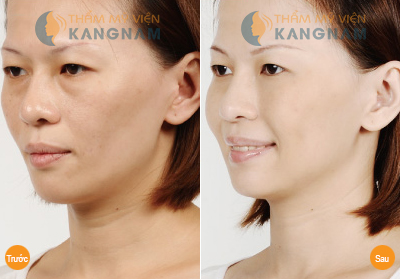 Trị bọng mắt bẩm sinh có đơn giản không?889