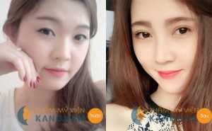 Bấm mí mắt Dove Eyes Hàn Quốc tạo mắt 2 mí đẹp vĩnh viễn