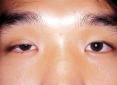 Giải phẫu thẩm mỹ mắt sụp mí có để lại sẹo không?