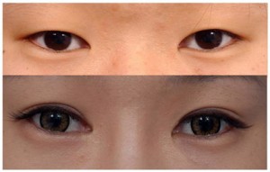 Thẩm mỹ mắt 2 mí Hàn Quốc hết bao nhiêu tiền?
