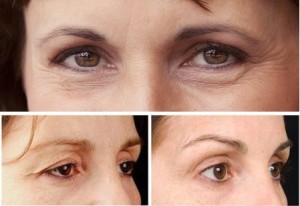 Cắt mí mắt trên – Giải pháp hoàn hảo khắc phục da chùng, mỡ thừa