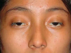 Bệnh sụp mí bẩm sinh dưới “con mắt” chuyên gia