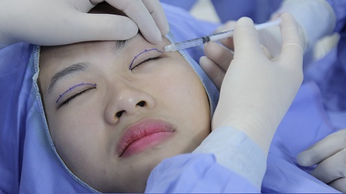 Bệnh sụp mí bẩm sinh dưới “con mắt” chuyên gia4