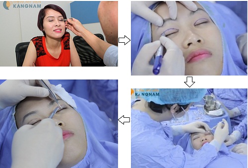 Cắt mí mắt Hàn Quốc - Mắt đẹp trẻ trung, phục hồi nhanh chóng5