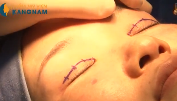 3 mẹo “hô biến” mắt to tròn như sao Hàn