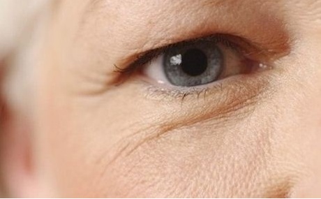 Nên chữa sụp mí mắt ở người già bằng cách nào? 1