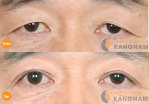 Lấy mỡ mí mắt dưới công nghệ Hàn Quốc có nguy hiểm không?3