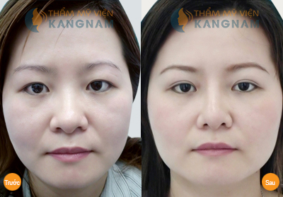 Cắt mí mắt Kangnam's Eyelid – Mắt 2 mí đều đẹp trẻ trung bảo hành vĩnh viễn8999