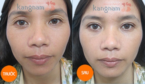 Cắt mí mắt Eyelid34688