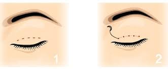 Cắt mí mắt Kangnam's Eyelid – Mắt 2 mí đều đẹp trẻ trung bảo hành vĩnh viễn89