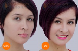 Cắt mí mắt Kangnam’s Eyelid giá bao nhiêu tiền?