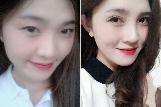 Mắt một mí có cách nào khắc phục được không?7888
