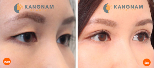 Cắt mí mắt có đau hay để lại sẹo không?7888