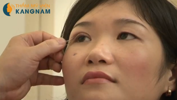 Làm sao để hết bọng mắt nhanh chóng?777