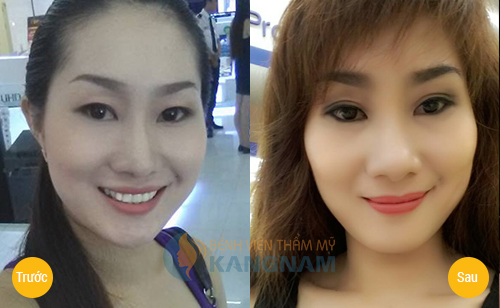 Chia sẻ: có nên cắt mí mắt không? 7