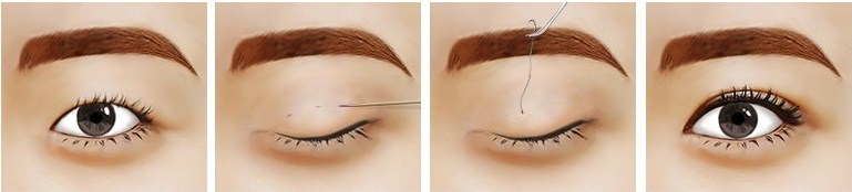 Da mắt bị chùng - Nên cắt mí hay bấm mí? Chuyên gia chia sẻ 7 Da mắt bị chùng - Nên cắt mí hay bấm mí? Chuyên gia chia sẻ 6