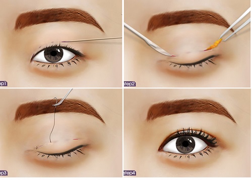 Da mắt bị chùng - Nên cắt mí hay bấm mí? Chuyên gia chia sẻ 4 Da mắt bị chùng - Nên cắt mí hay bấm mí? Chuyên gia chia sẻ 3