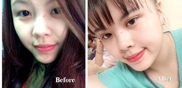 Bấm mí khác cắt mí18
