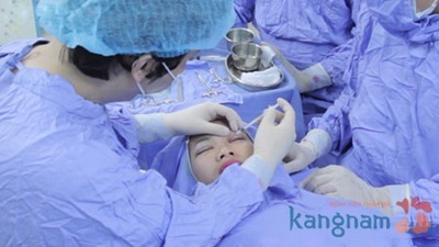 Tạo (cắt) khóe mắt45 