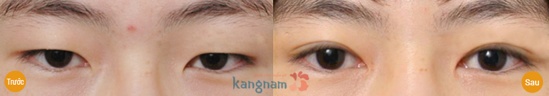 Tạo (cắt) khóe mắt23436 