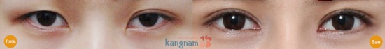 Tạo (cắt) khóe mắt45 