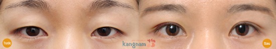 Tạo (cắt) khóe mắt457 