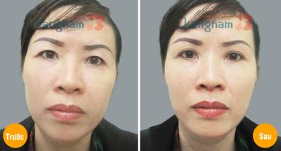 Chăm sóc sau nâng cung mày567 