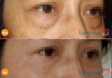 kinh nghiệm cắt bọng mỡ mắt356 5
