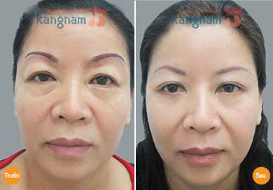 Khách hàng hài lòng với kết quả cắt da thừa mí mắt tại Kangnam Chia sẻ kết quả cắt da thừa mí mắt tại BVTM Kangnam