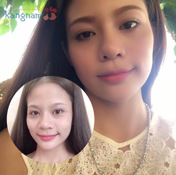 Cắt bọng mỡ mắt ở đâu đẹp99