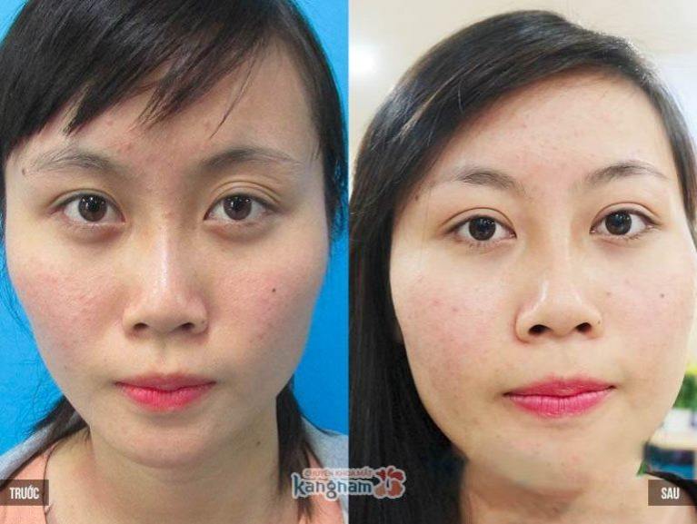 Phẫu thuật cắt bọng mắt ở đâu đẹp nhất?899
