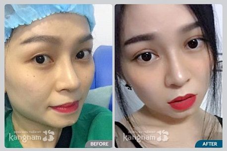 Cắt mí mắt6666