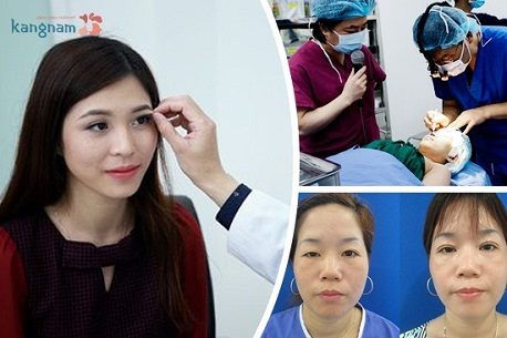 Cắt mí mắt88