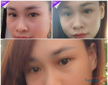 Cắt mí mắt88