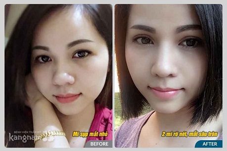 Cắt mí mắt66