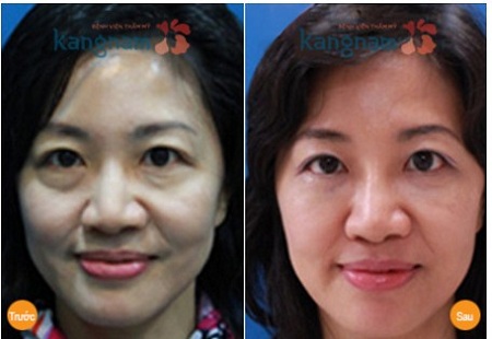 Cắt mí mắt dưới trẻ ra đến 10 tuổi Cắt mí mắt dưới trẻ ra đến 10 tuổi