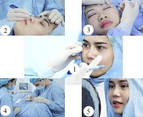 Quy trình lấy mỡ mí mắt trên tại Kangnam
