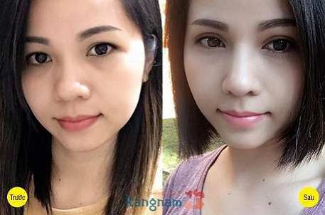 Kết quả trước sau lấy mỡ mí mắt trên tại Kangnam