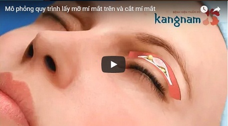 Mô phỏng quá trình lấy mỡ mí mắt trên